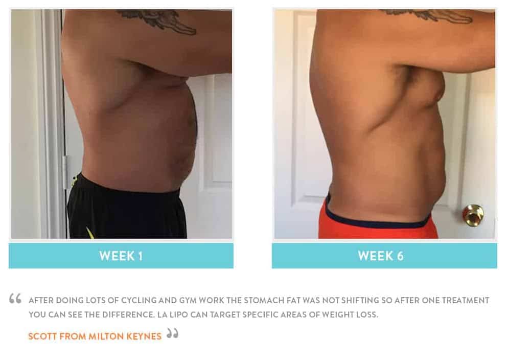 Before & After Stomach Fat Greater London (Harrow)
