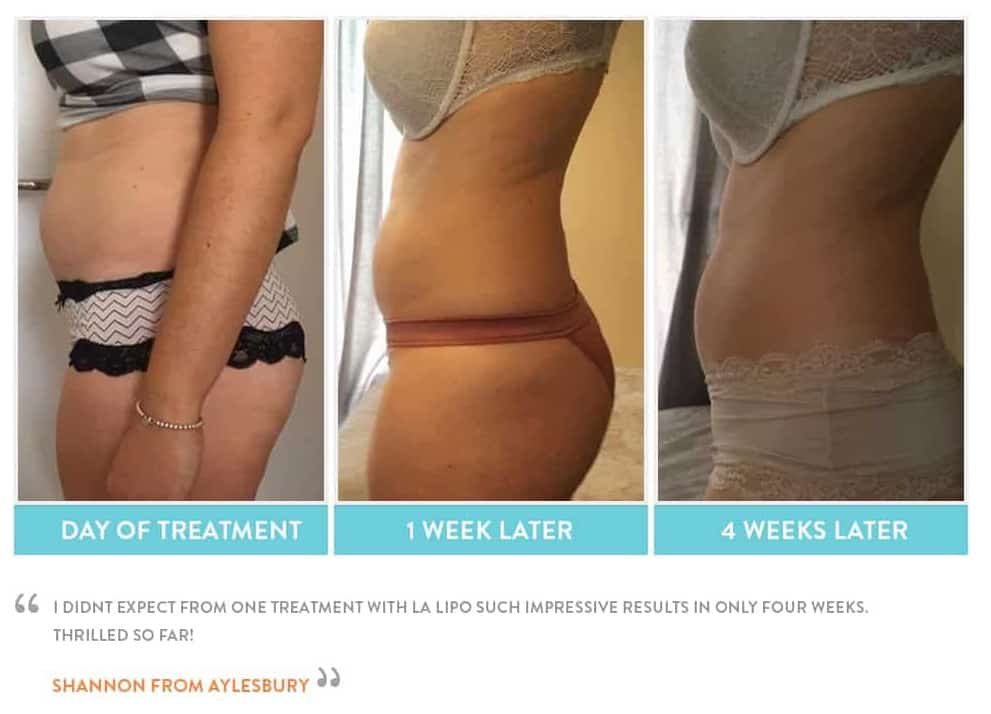 before, Cryolipolysis Greater London (Harrow)