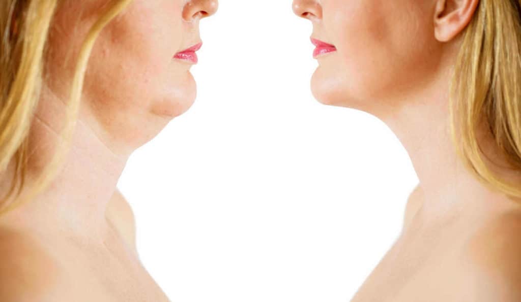 Double Chin treatment Greater London (Harrow) before and after results