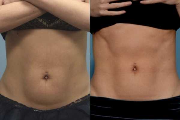 body sculpting FAQs Greater London (Harrow)