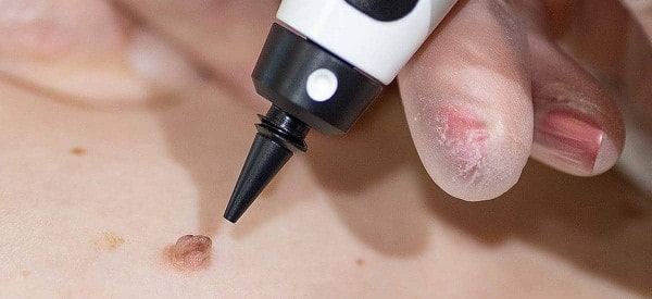 After Skin Tag Removal Greater London (Harrow)