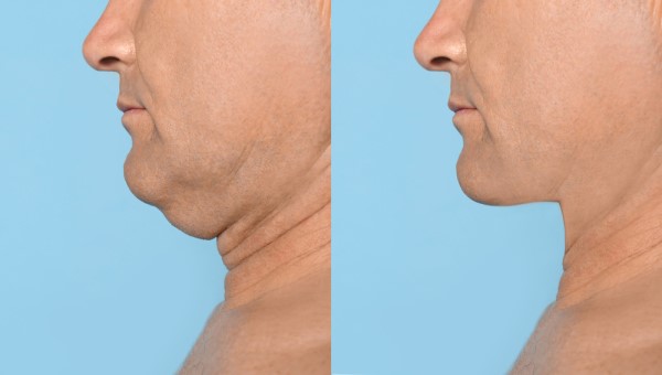 Which Non-Surgical Treatments Work Best for Jowls and Loose Skin Greater London (Harrow)?