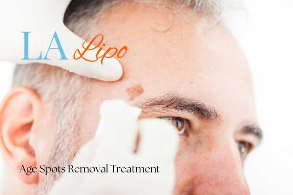 What Are the Most Effective Treatments for Age Spots Greater London (Harrow)?
