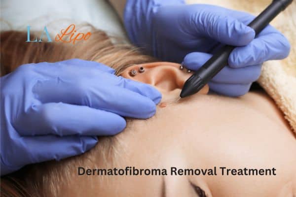 Dermatofibroma Removal Treatment Greater London (Harrow)