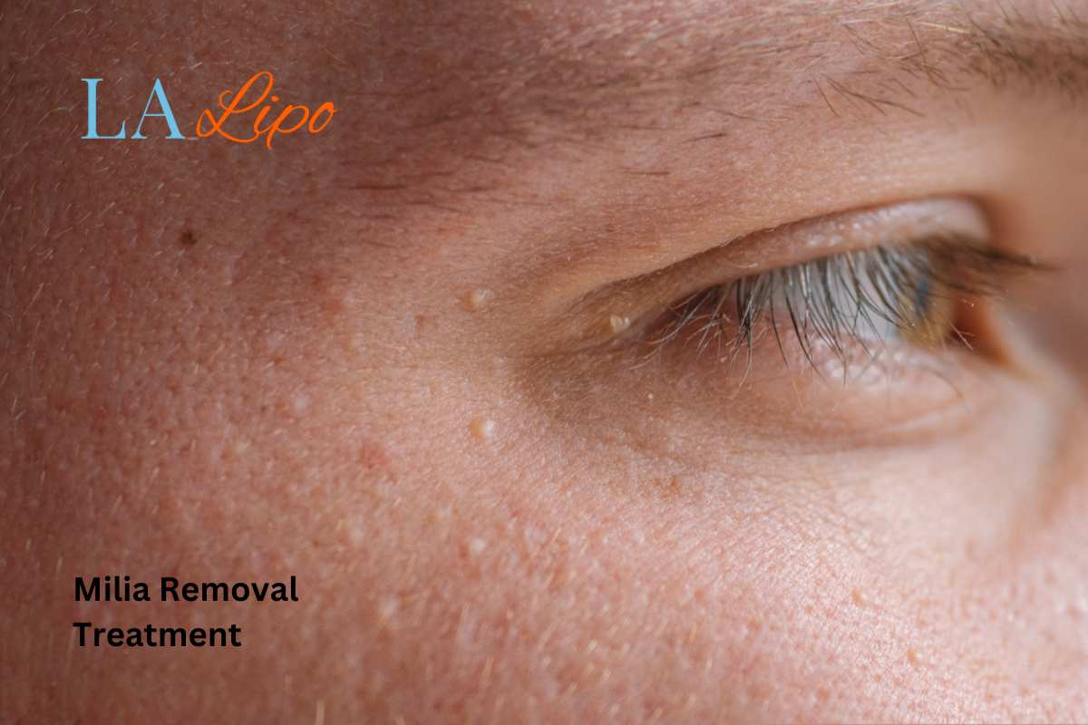 Cryopen Milia Removal: Is It the Easiest and Safest Option Greater London (Harrow)?