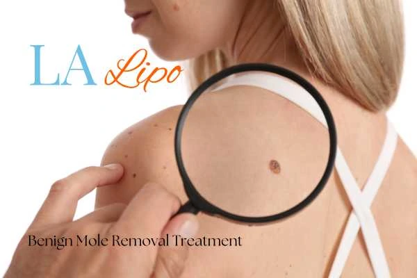 Why getting moles removed Greater London (Harrow) can boost your confidence!