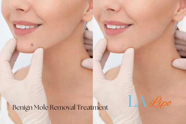 woman's before and after mole removal Greater London (Harrow) results