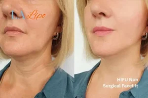 hi-fu for wrinkles Greater London (Harrow) before and after results