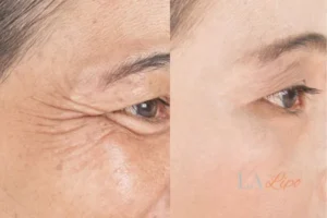 Before and after results of woman - HI-fu wrinkles reduction treatment Greater London (Harrow)