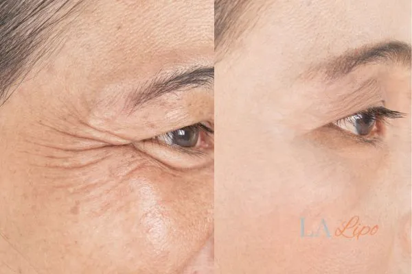 Before and after results of woman - HI-fu wrinkles reduction treatment Greater London (Harrow)