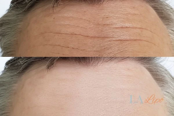 results of HIFU Greater London (Harrow) on mans forehead to help reduce lines and wrinkles