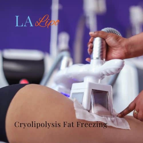 fat freezing - Cryolipolysis Greater London (Harrow)