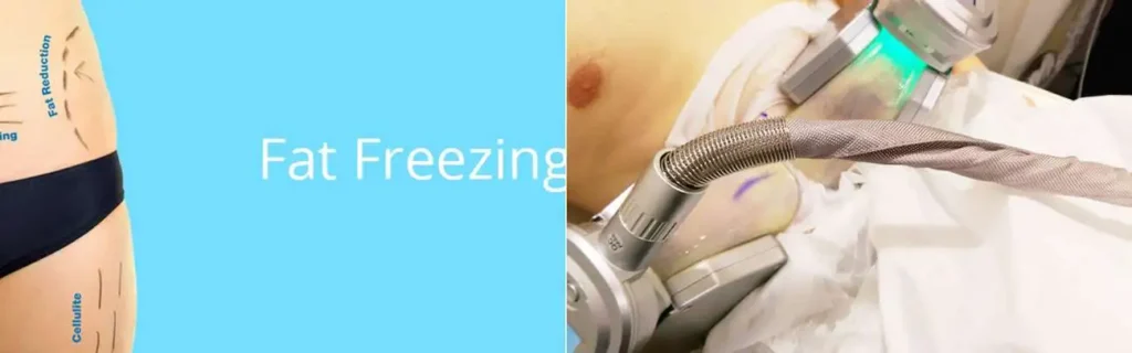 Fat freezing Greater London (Harrow) on multiple areas of the body