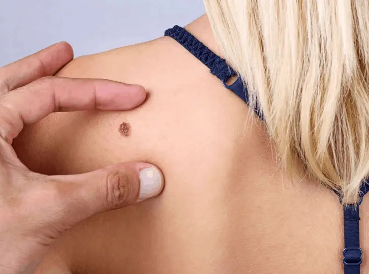 woman having mole removal Greater London (Harrow) consultation before treatment.