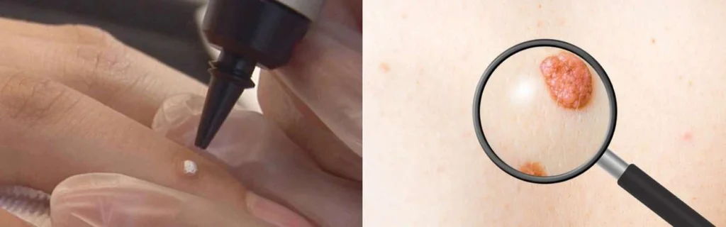 Person getting moles removed with cryopen Greater London (Harrow)