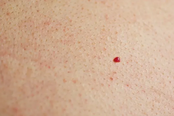 close up of a cherry angioma Greater London (Harrow)