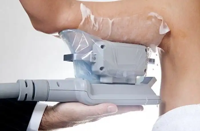 Picture of fat freezing Greater London (Harrow) on the upper arms.