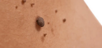 image of a skin tag Greater London (Harrow)