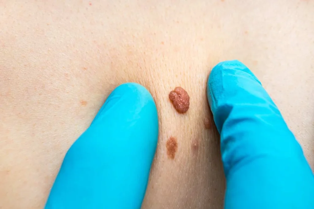 Consultant examining a skin tag Greater London (Harrow)