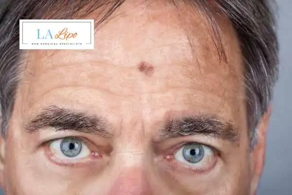 Solar Lentigo Removal Greater London (Harrow) image of man with mark on his forehead