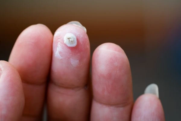 wart on person finger - cryotherapy to treat from LA LIPO Greater London (Harrow)
