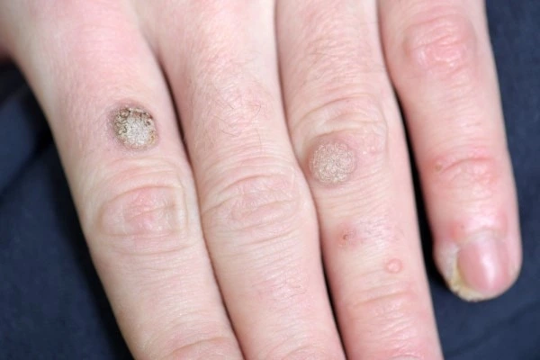 photo of warts on person hand - see wart removal Greater London (Harrow) from LA LIPO