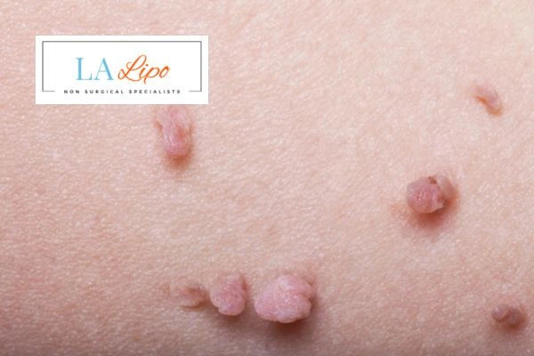 Does cryopen skin tag removal Greater London (Harrow) hurt? Find out now call our team today!