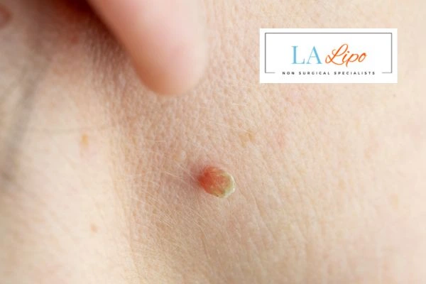 Book skin tag removal Greater London (Harrow) today speak to our team now!