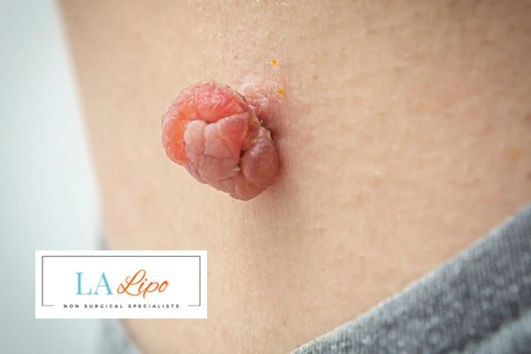 Interested in skin tag removal Greater London (Harrow)? Concerned about the pain? Find out more today!