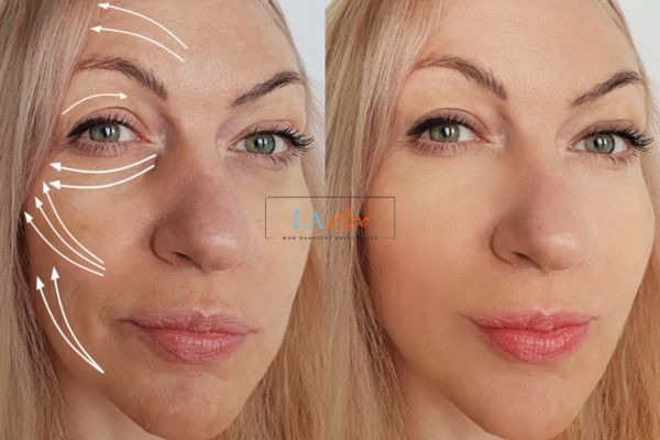 Morpheus 8 results Greater London (Harrow) face lift.