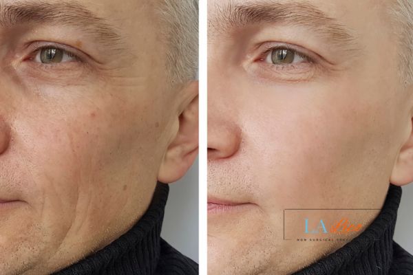 See the amazing results of Morpheus8 Treatment Greater London (Harrow)!