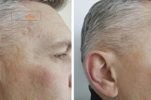 Mens Before & After Morpheus 8 Results Greater London (Harrow)