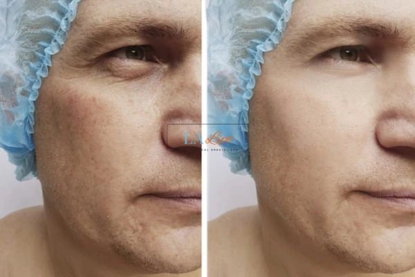 Before and after Morpheus 8 Results Greater London (Harrow)