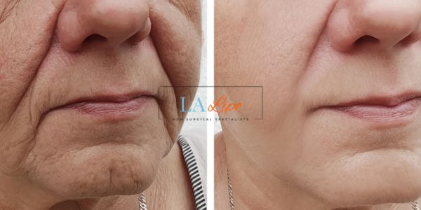 Older lady deeper wrinkle reduction - LA LIPO Morpheus 8 Results Greater London (Harrow)
