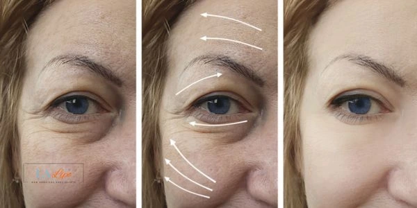 Amazing eye lift Morpheus 8 results Greater London (Harrow)