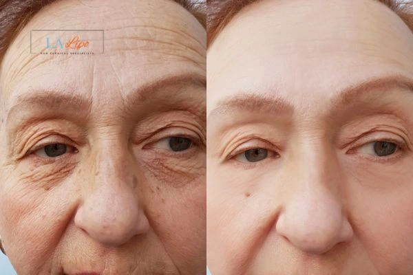 The powerful benefits of Morpheus8 Treatment Greater London (Harrow) - Call Our team today!