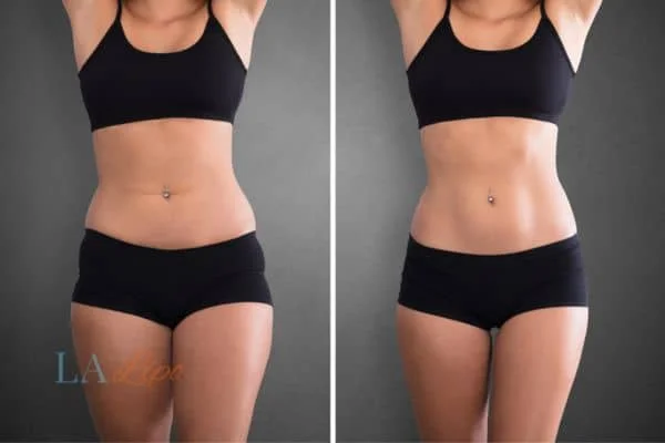 before and after results of non-surgical treatment to help a woman's body image and mental health Greater London (Harrow)