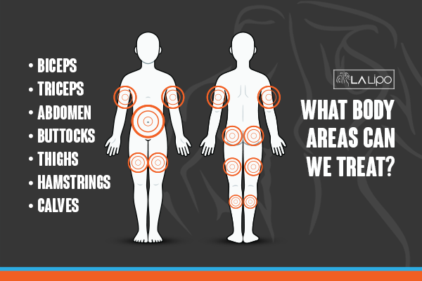 Diagram to show areas you can have LA-EMS Body Sculpting Treatment Greater London (Harrow)