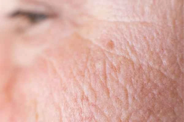 close up picture of a woman's face showing an age spot Greater London (Harrow)