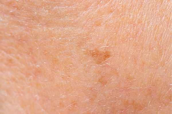 close up picture of age spots Greater London (Harrow)