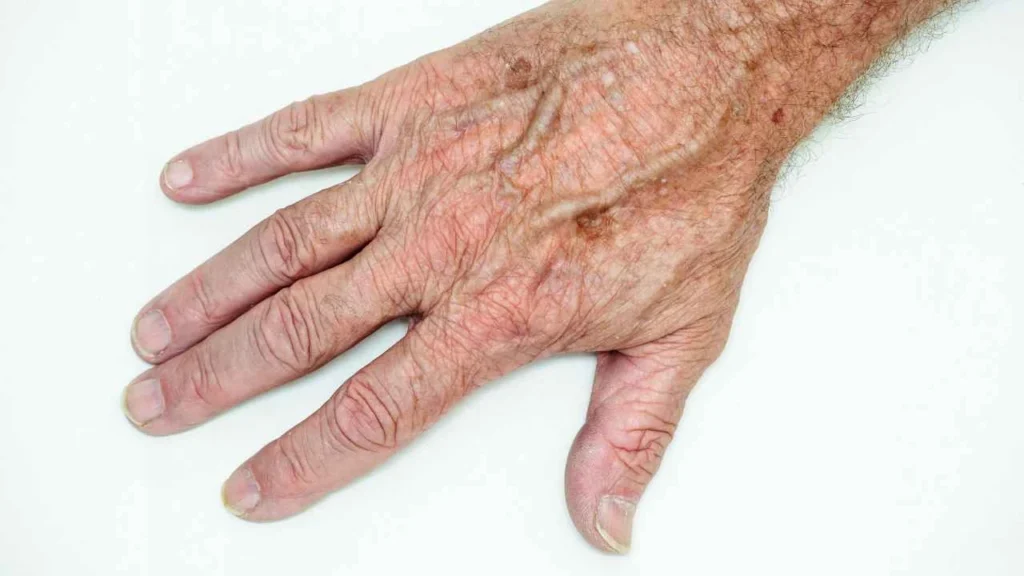 Male hand showing age spot Greater London (Harrow)