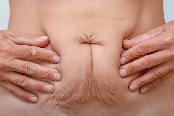 Image of a woman's stomach with loose skin - example of skin tightening Greater London (Harrow) options