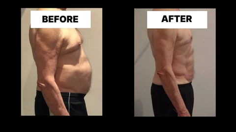 What Symptoms Can Diastasis Recti Cause in Men? Weak Core, Back Pain and Poor Posture Greater London (Harrow)